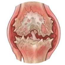 Stiff, achy joints